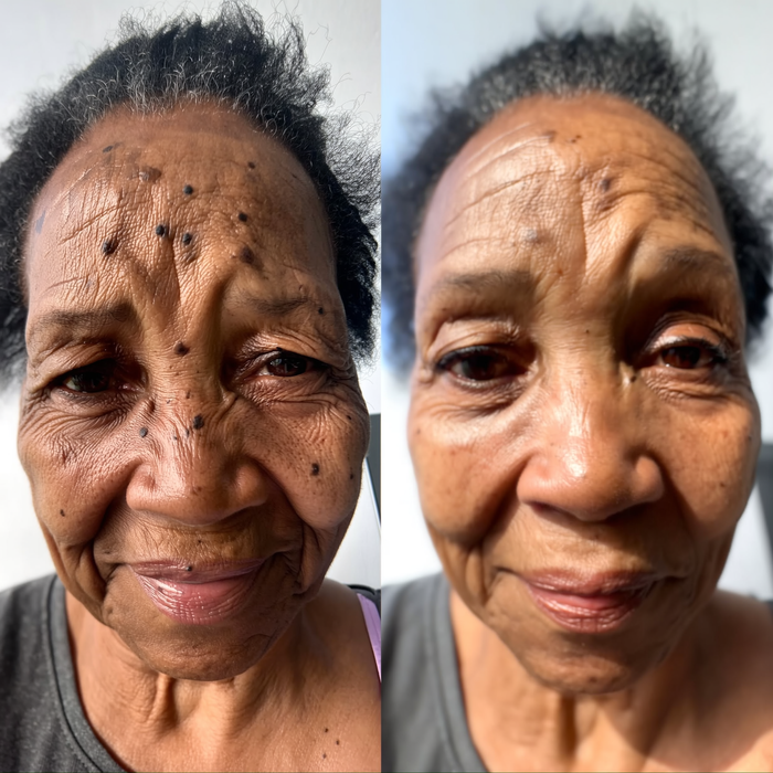 Before After Rachel D. 67y